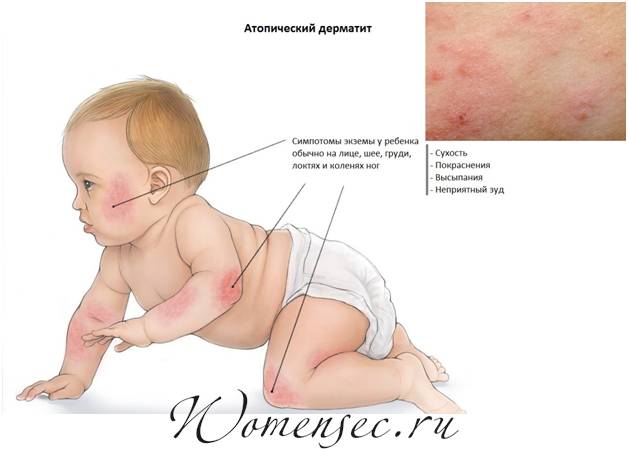 Как вылечить дерматит у ребенка комаровский